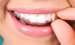 invisalign