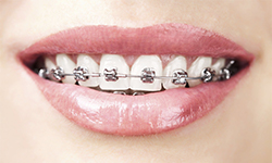 metal braces